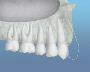 An example of a jaw with inadequate front bone structure to support an implant