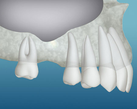 A jaw lacking enough bone in the back of the mouth for a dental implant