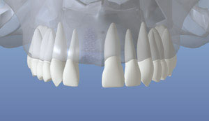 A representation of a healed upper jaw bone after losing a tooth