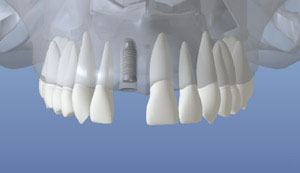 A digital representation of the initial dental implant placed in the jaw bone