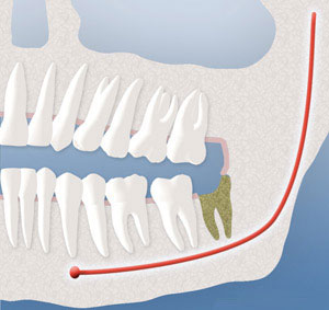 A visual of dry socket that developed after the removal of wisdom teeth