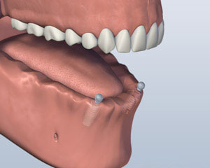 After Dental Implants Placed