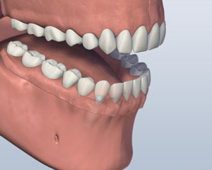 Denture Attached