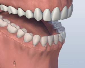Denture Attached