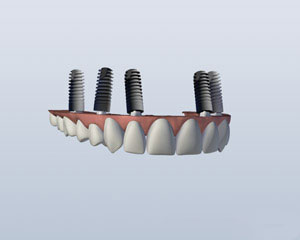 Implant Retained Upper Denture Implant Retained Upper Denture